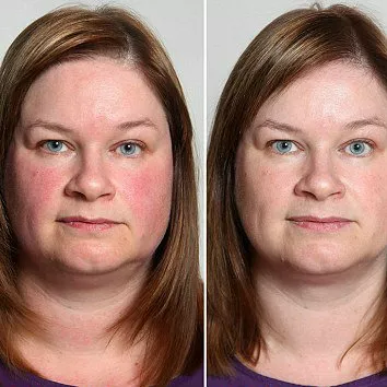 Stoppen met drinken: het effect op je huid