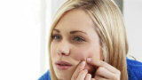 Acne, wat moet je ermee?