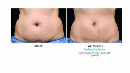 Deskundige Kristel vertelt je alles wat je wilde weten over CoolSculpting