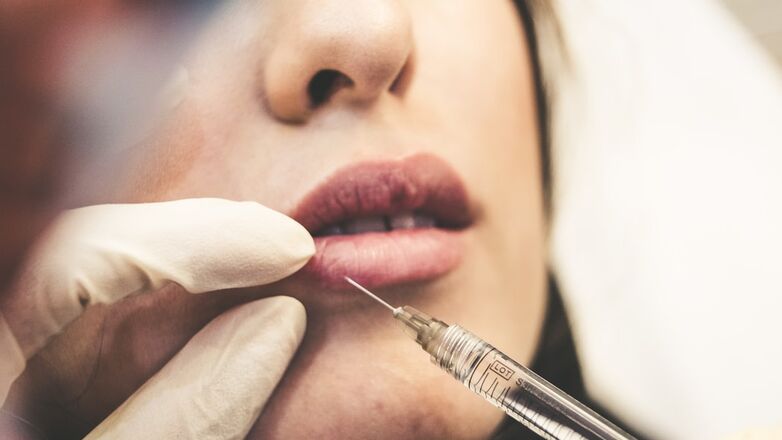 Botched lipfillers laten oplossen: waarom de 'natural look' nu toch weer in is