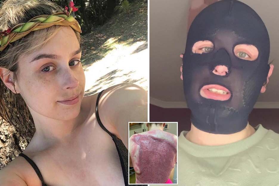 Stephanie (24) stond naast een vulkaanuitbarsting: '70% van mijn lichaam is verbrand' 