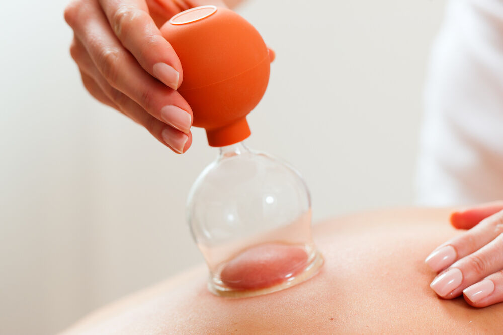 Cupping is weer populair: dit zijn de voordelen