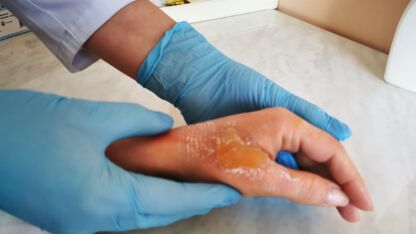 Allison (17) haar huid brandde af nadat ze deze viral DIY ontharingsmethode probeerde