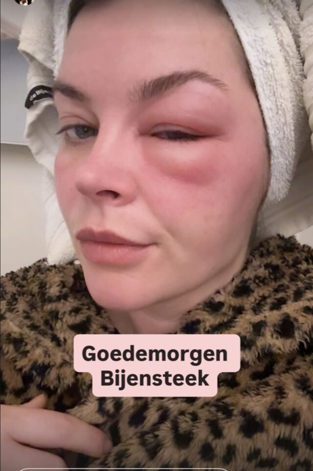 Miljuschka Witzenhausen heeft een opgezwollen oog na bijensteek